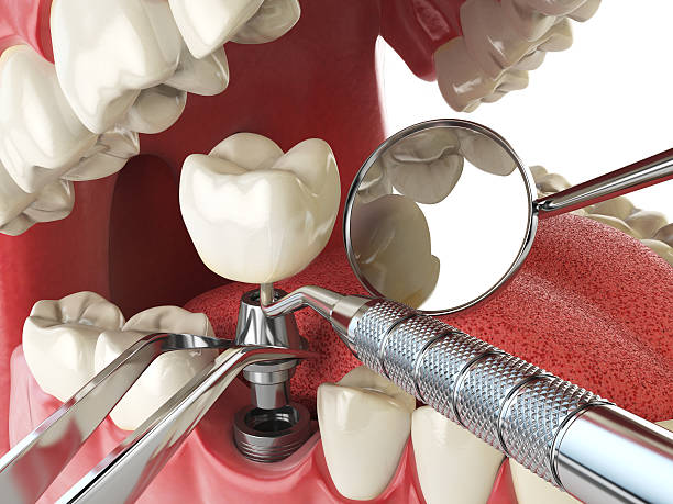 Best Emergency Gum Treatment in East Lansing, MI